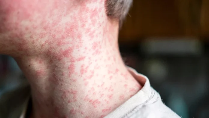 measles