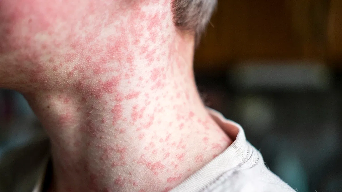 Why Are Unvaccinated Communities More Vulnerable to Measles?
